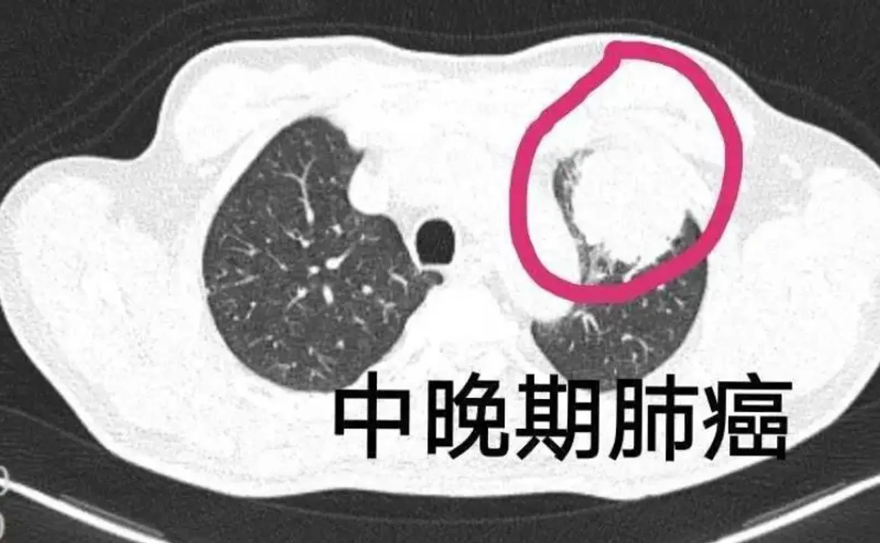 能杀死所有实体癌瘤的新药又被媒体研发出来了