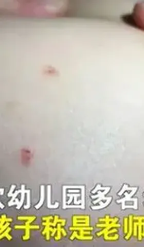 幼儿园老师用牙签扎孩子，这是第几十起案件了？ ！