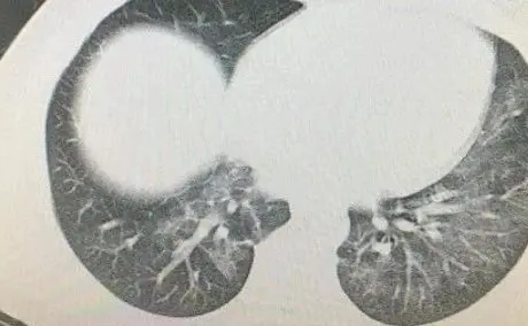 是谁在用大白肺吓唬我们？